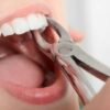 Dental Extraction: Basic Principles