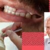 Removable Partial Dentures | Teaching & Academics Science Online Course by Udemy