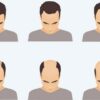 How to STOP male pattern hair loss & REGROW your own hair! | Health & Fitness General Health Online Course by Udemy